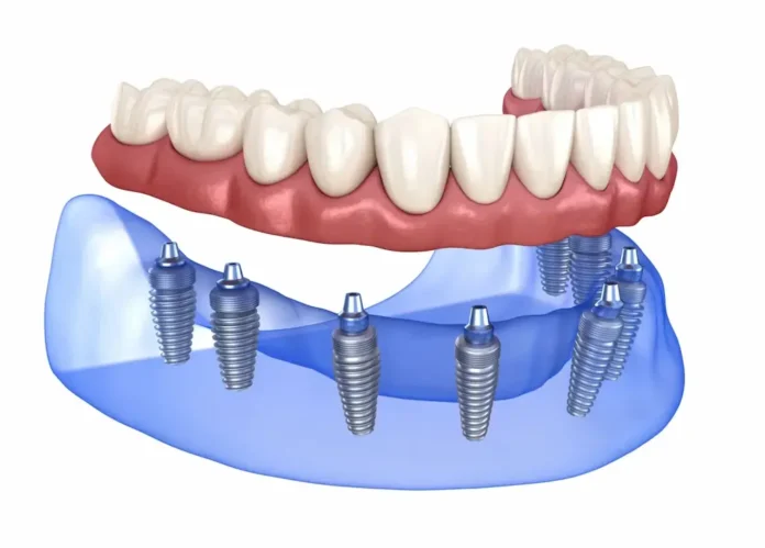 Протезування на імплантах